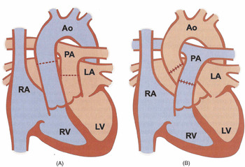 Frontiers  Right and Left Ventricular Strain Patterns After the Atrial  Switch Operation for D-Transposition of the Great Arteries—A Magnetic  Resonance Feature Tracking Study