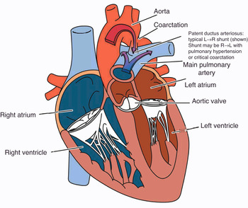 Estimation of Left Ventricular Filling Pressure Using Left Atrial Strain in  Coarctation of Aorta