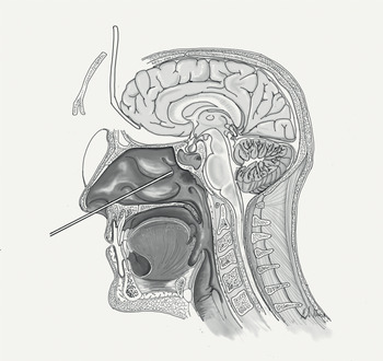 Endoscopic Endonasal (EN) Combined Approaches (Section I