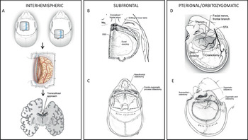 Combined Endoscopic Endonasal and Transcranial Approach to Complex 