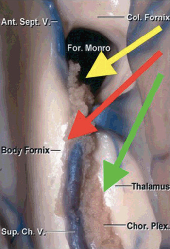 Pushing lump inferiorly produces concavity of the overlying skin (arrows)