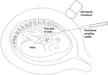 A textbook of obstetrics . Fig. 253. Presentation I the umbili