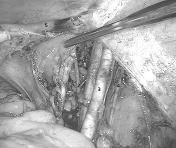 Epinephrine minimizes the use of bipolar coagulation and preserves ovarian  reserve in laparoscopic ovarian cystectomy: a randomized controlled trial