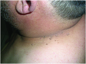 Figure 2 from Giant Achrocordon in a Patient With Acromegaly