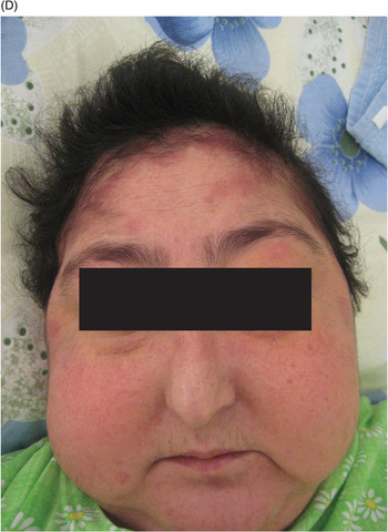 Figure 2 from Giant Achrocordon in a Patient With Acromegaly