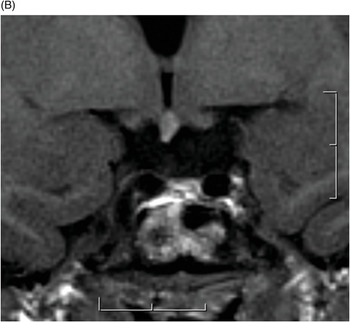 Magnetic Resonance Imaging Contrast Medium Injections Sagittal View Case Of  Pituitary Mass High-Res Stock Photo - Getty Images