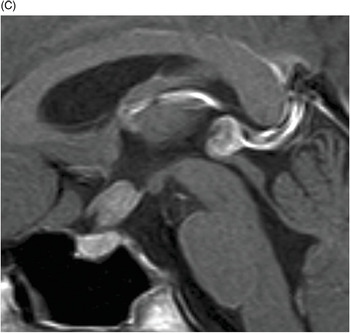 Comparison of MRI slices at the mid calf showing the anatomy with an IP