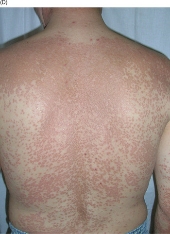 A 10-year-old girl of MORFAN syndrome with Acanthosis nigricans.
