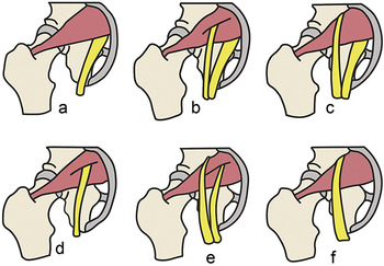 Sciatica & Piriformis Syndrome in Runners, by Alina Kennedy