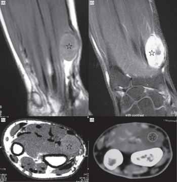 Imaging of Tumors and Pseudotumors of Soft Tissues (Chapter 2