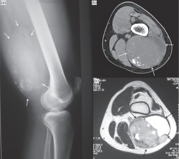 Imaging of Tumors and Pseudotumors of Soft Tissues (Chapter 2
