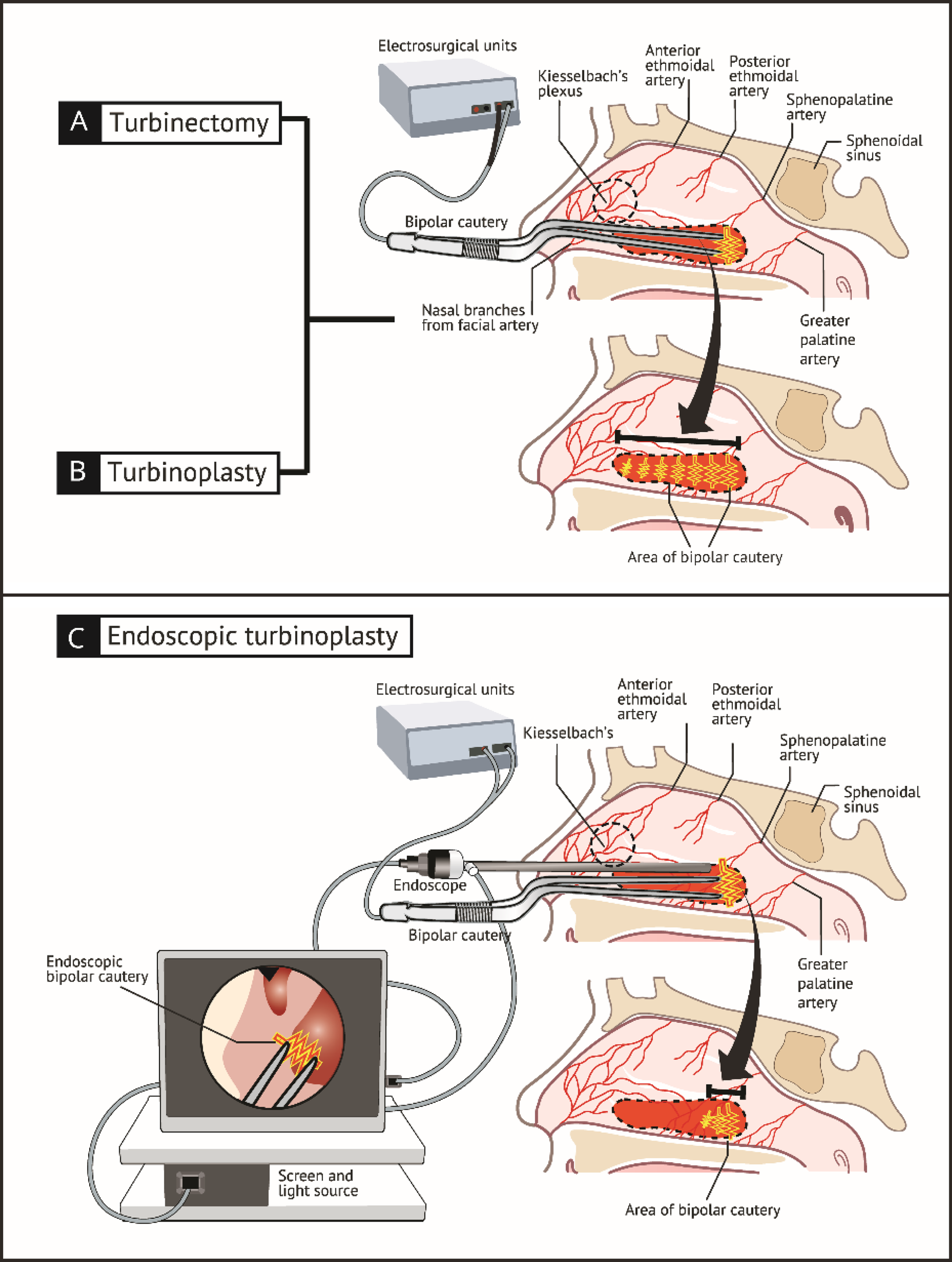 Inferior Turbinate Reduction Comparing Post Operative Bleeding Between