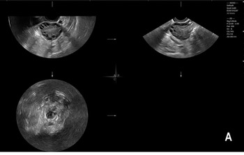 Ovarian Cysts 101 - Penn Medicine