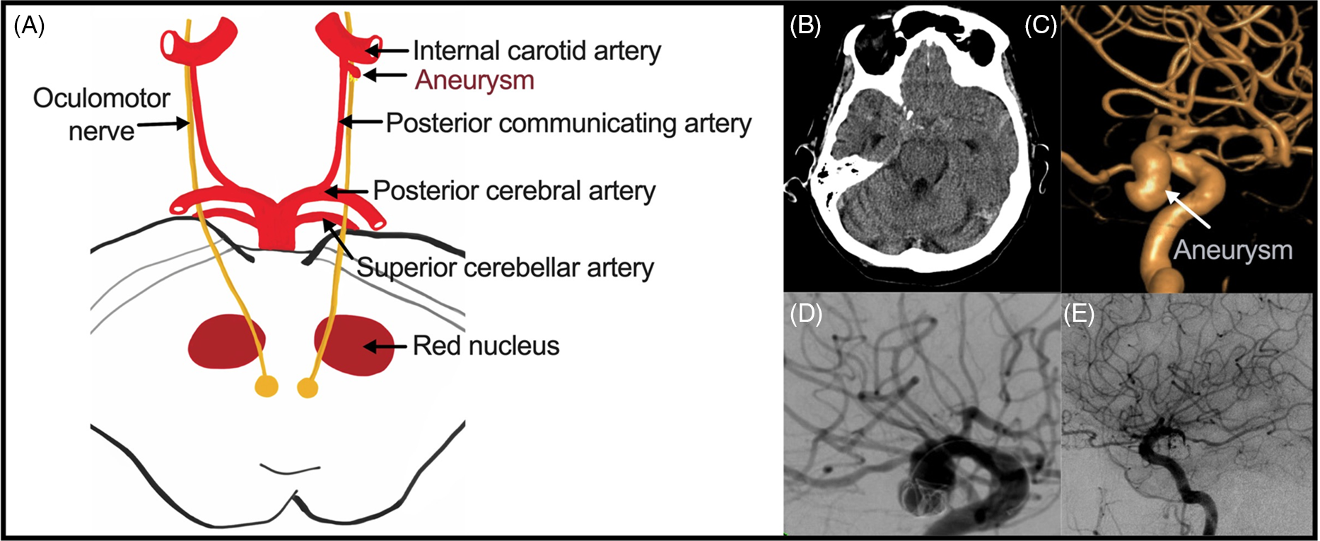 Third Nerve Palsy Due To Intracranial Aneurysms And Recovery After