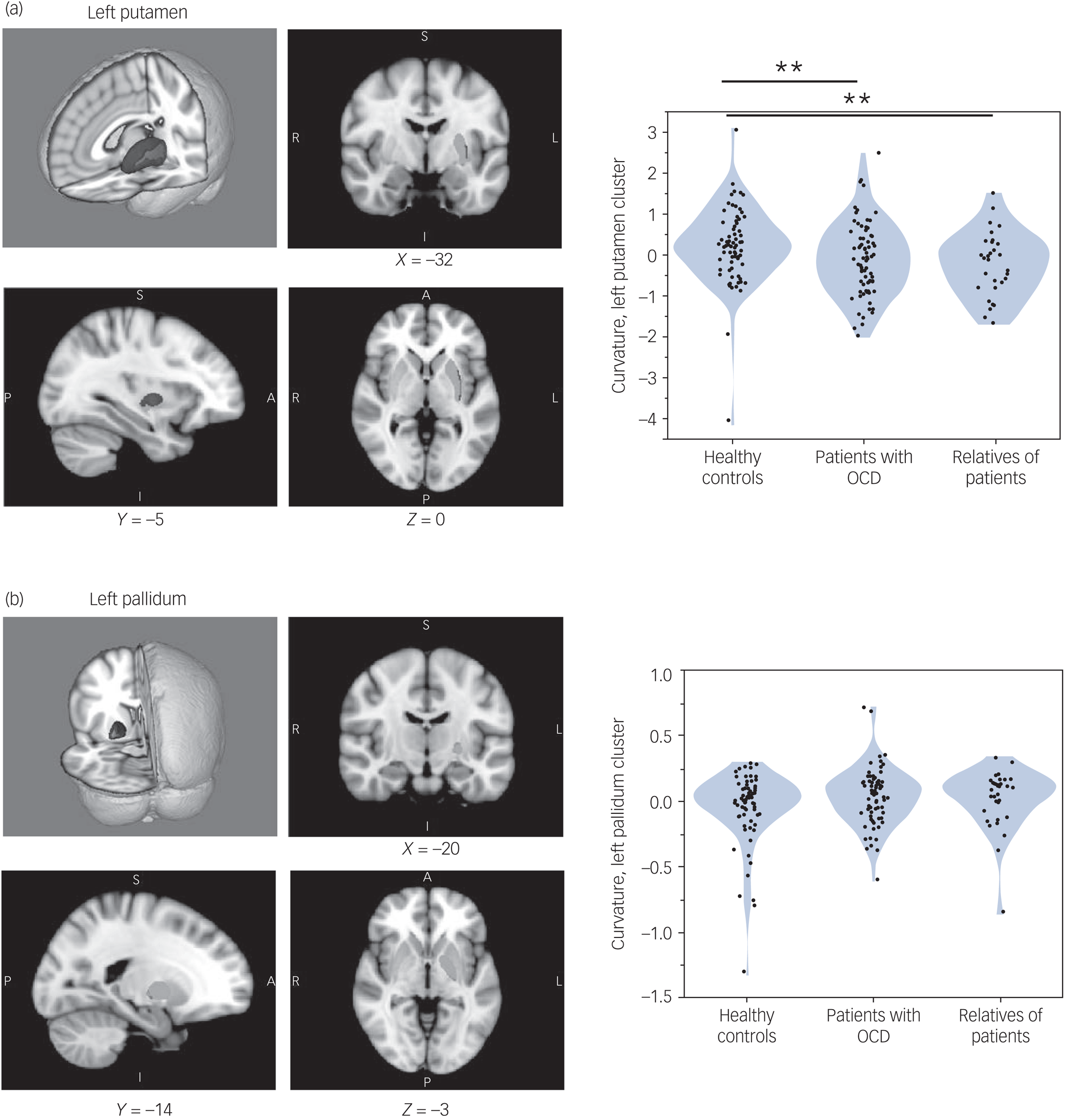 Setshiftingrelated basal ganglia deformation as a novel familial marker of obsessive