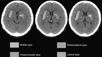 retatrutide ganglia hemorrhage Basal ganglionic hemorrhages (Chapter 44)