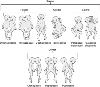 Types Of Conjoined Twins