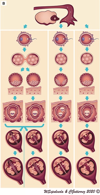 Zygosity, Chorionicity and Amnionicity (Chapter 3) - Management of Multiple  Pregnancies