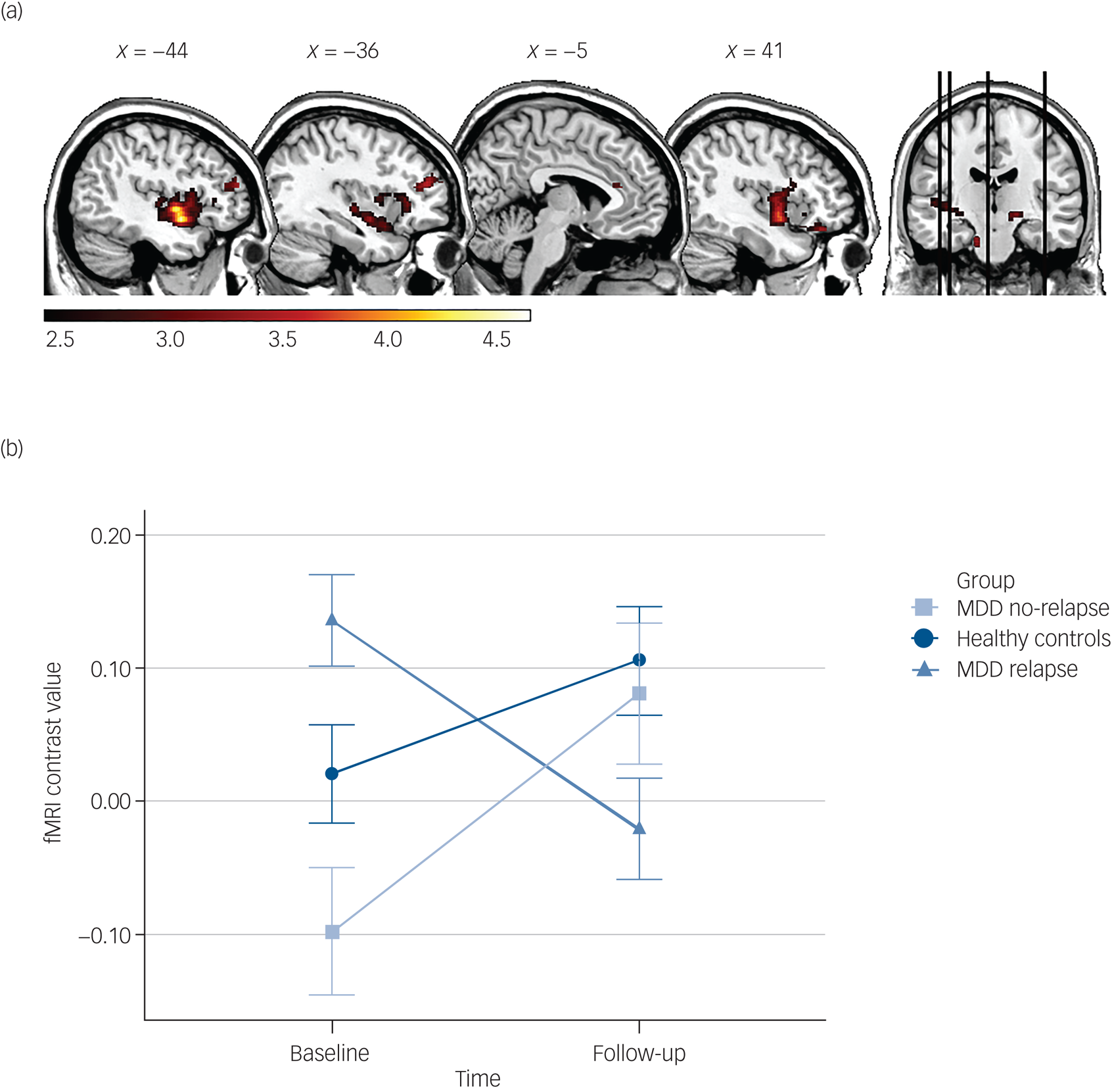Changes in brain function during negative emotion processing in the ...