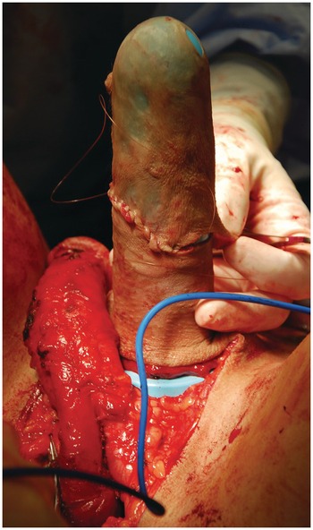 Prevention and Management of Neovaginal Stenosis and Other Related