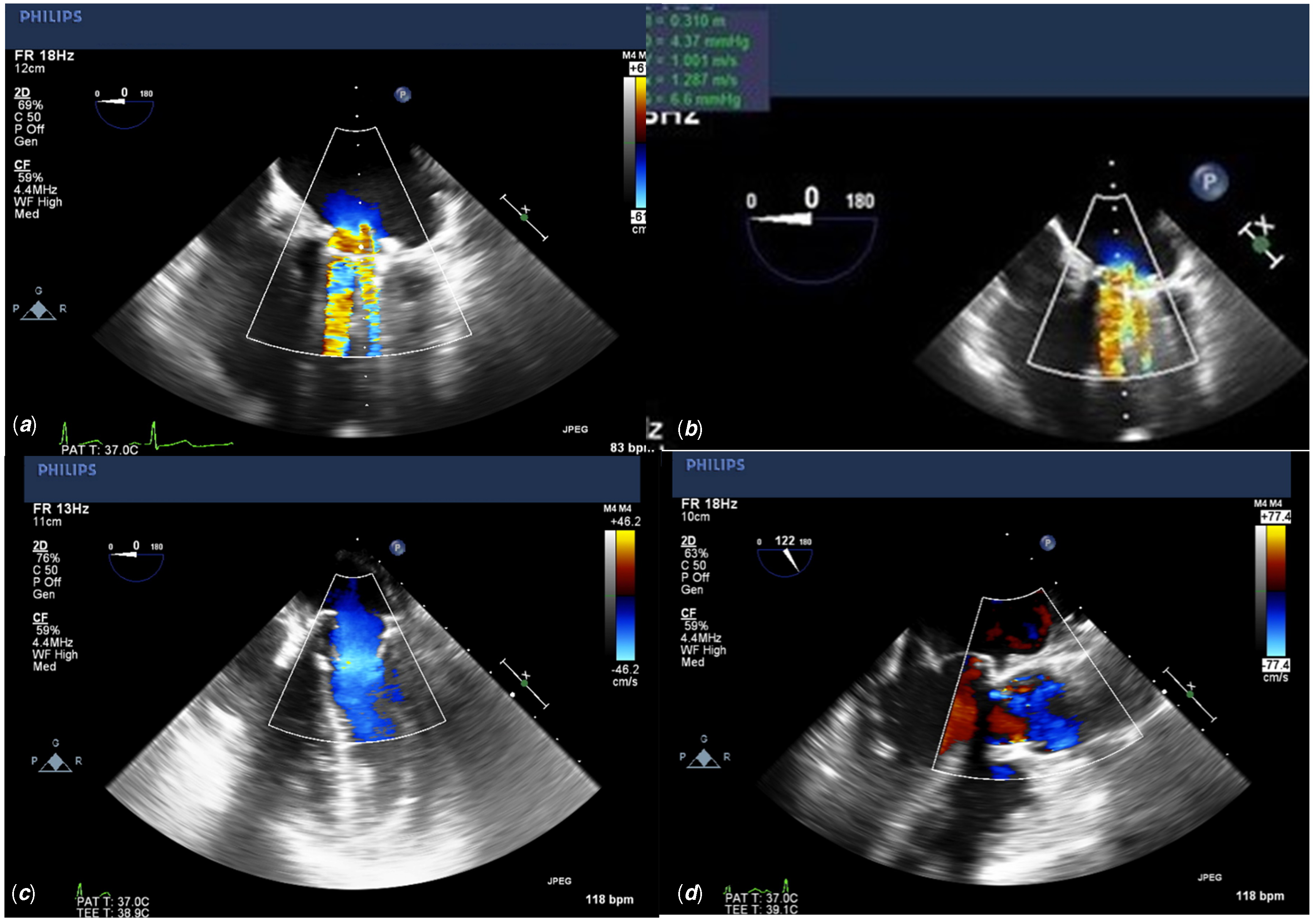 The MITRIS RESILIA mitral valve is a safe and effective option for ...