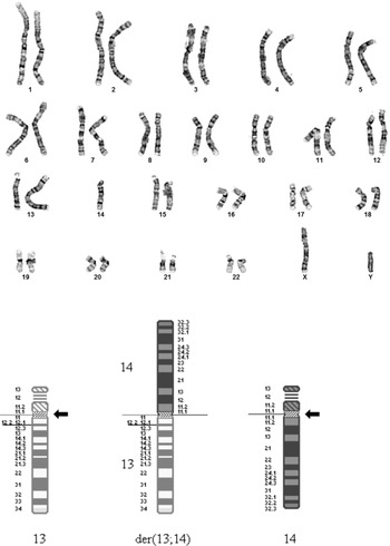achondroplasia karyotype chromosome 4