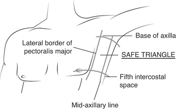 Triangle of safety as outlined by the superior aspect of the fifth rib