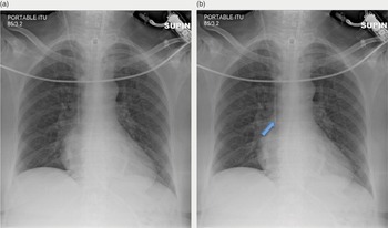 Imaging of the Chest (2.8) - Intensive Care Medicine