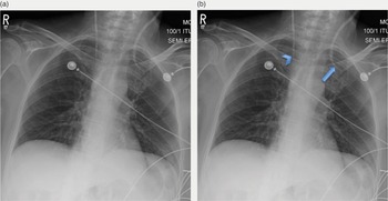Imaging of the Chest (2.8) - Intensive Care Medicine