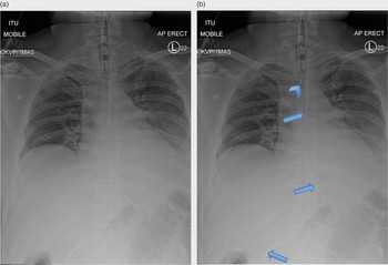 Imaging of the Chest (2.8) - Intensive Care Medicine