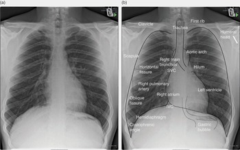 Imaging of the Chest (2.8) - Intensive Care Medicine