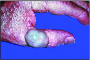 Hemangiomas, lymphangiomas, and reactive vascular proliferations ...