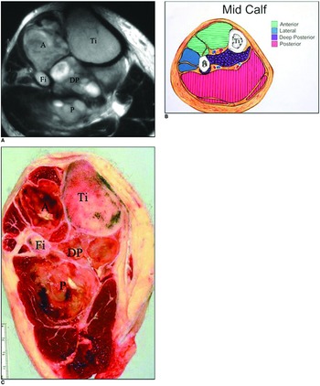 Radiologic evaluation of soft tissue tumors (Chapter 2) - Modern Soft  Tissue Pathology