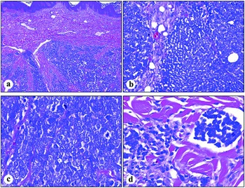 Histology Of Merkel Cell Carcinoma