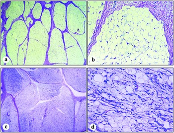 Spindle cell lipoma. (A) A fatty-tumor with interspersed fibro-myxoid