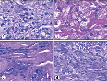 Nerve sheath tumors (Chapter 24) - Modern Soft Tissue Pathology