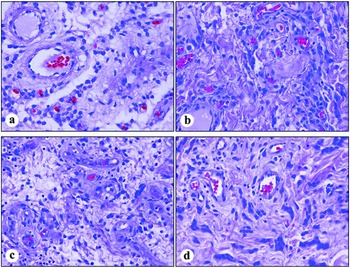 Angiomyofibroblastoma: A rare benign gynecologic tumor mistaken for a  bartholin cyst