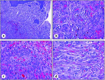 Gross image showing dilated and thick-walled blood vessels with