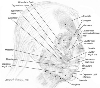 Treatment of Hemifacial Spasm with Botulinum Toxin Chapter 13