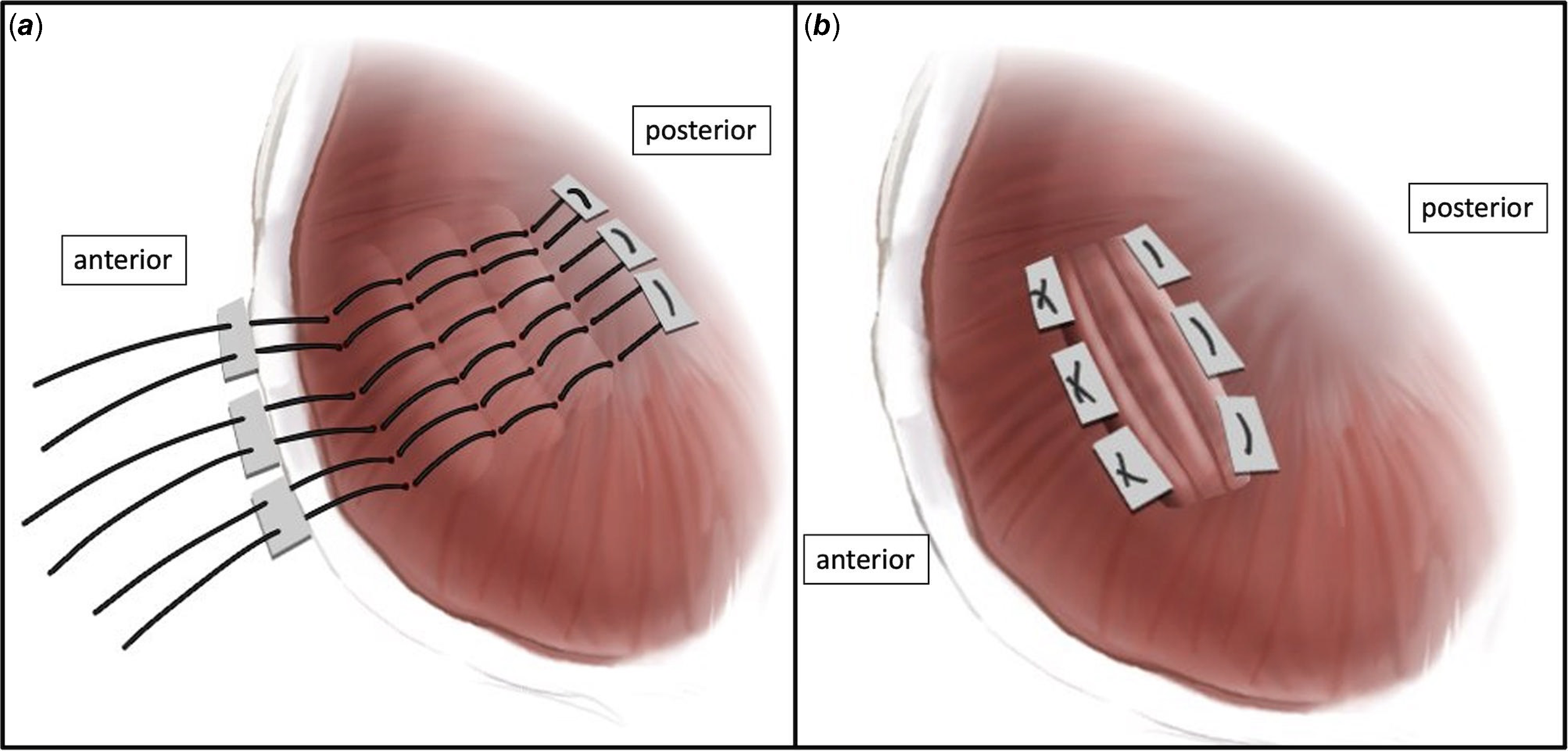 Plication for diaphragm paralysis after paediatric cardiac surgery: a ...