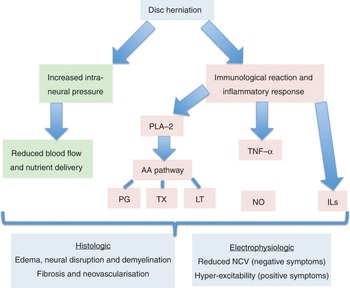 Radiculopathy (Chapter 18) - Neuroscience for Neurosurgeons