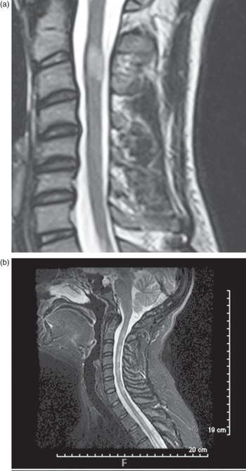 Traumatic and Nontraumatic Spinal Cord Disorders (Chapter 17 