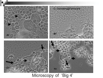 Bacterial Vaginosis: Watery Fish-Smelling Vaginal Discharge - 1210