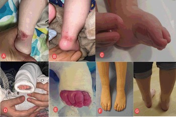 Isolated gastrocnemius tightness: impact on foot diseases