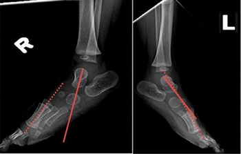 Normal dorsiflexion (left) & marked limitation of neck flexion (right).