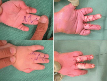 Orthopaedic Hand and Wrist Disorders (Chapter 16) - Postgraduate
