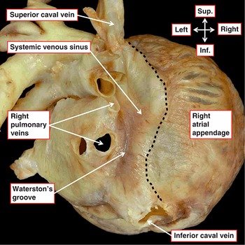 Wilcox's Surgical Anatomy of the Heart: 9781107014480