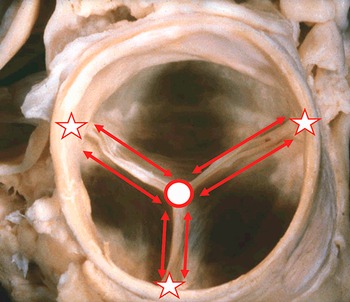 Surgical Anatomy of the Valves of the Heart (Chapter 4