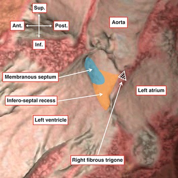 Surgical Anatomy of the Valves of the Heart (Chapter 4) - Wilcox's