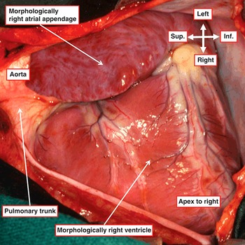 Positional Anomalies of the Heart (Chapter 11) - Wilcox's Surgical